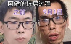 抗癌博主阿健因直腸癌病逝,抗癌小伙阿健去世